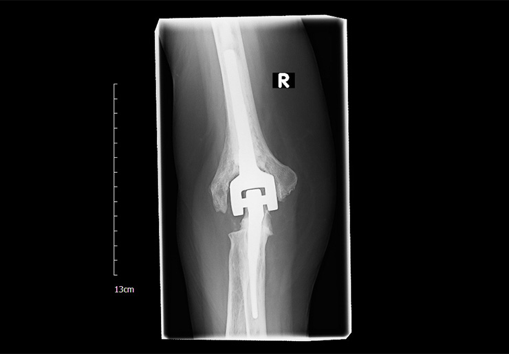 Röntgenbild einer Ellenbogenprothese gestreckt