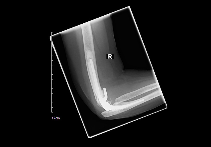 Röntgenbild einer Ellenbogenprothese gebeugt