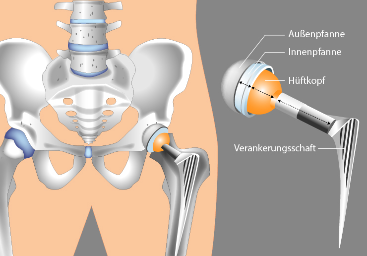 Illustration zum Aufbau einer Hüftprothese