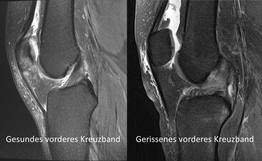 MRT-Aufnahmen eines gesundes und kaputten Kreuzbandes