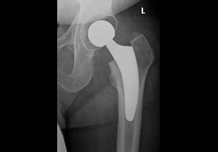 Röntgenbild einer zementfreien Kurzschaftprothese
