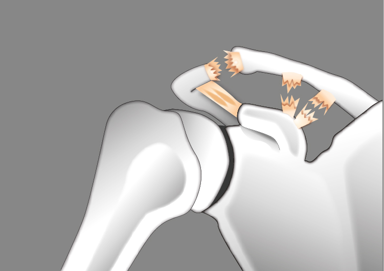 Illustration Verletzung des Schultereckgelenks