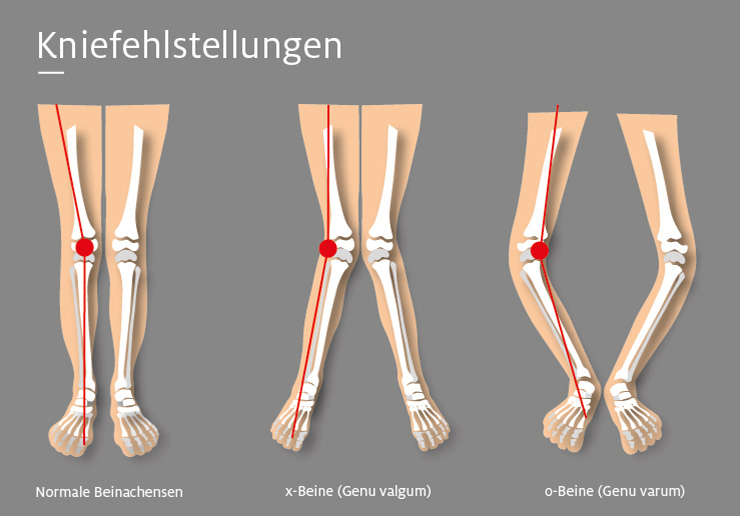 Grafik der verschiedenen Beinachsenfehlstellungen im Vergleich.